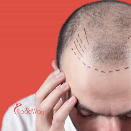 Hair Transplants in Turkey: Affordable Hair Restoration for Bahrain Men with Male Pattern Baldness